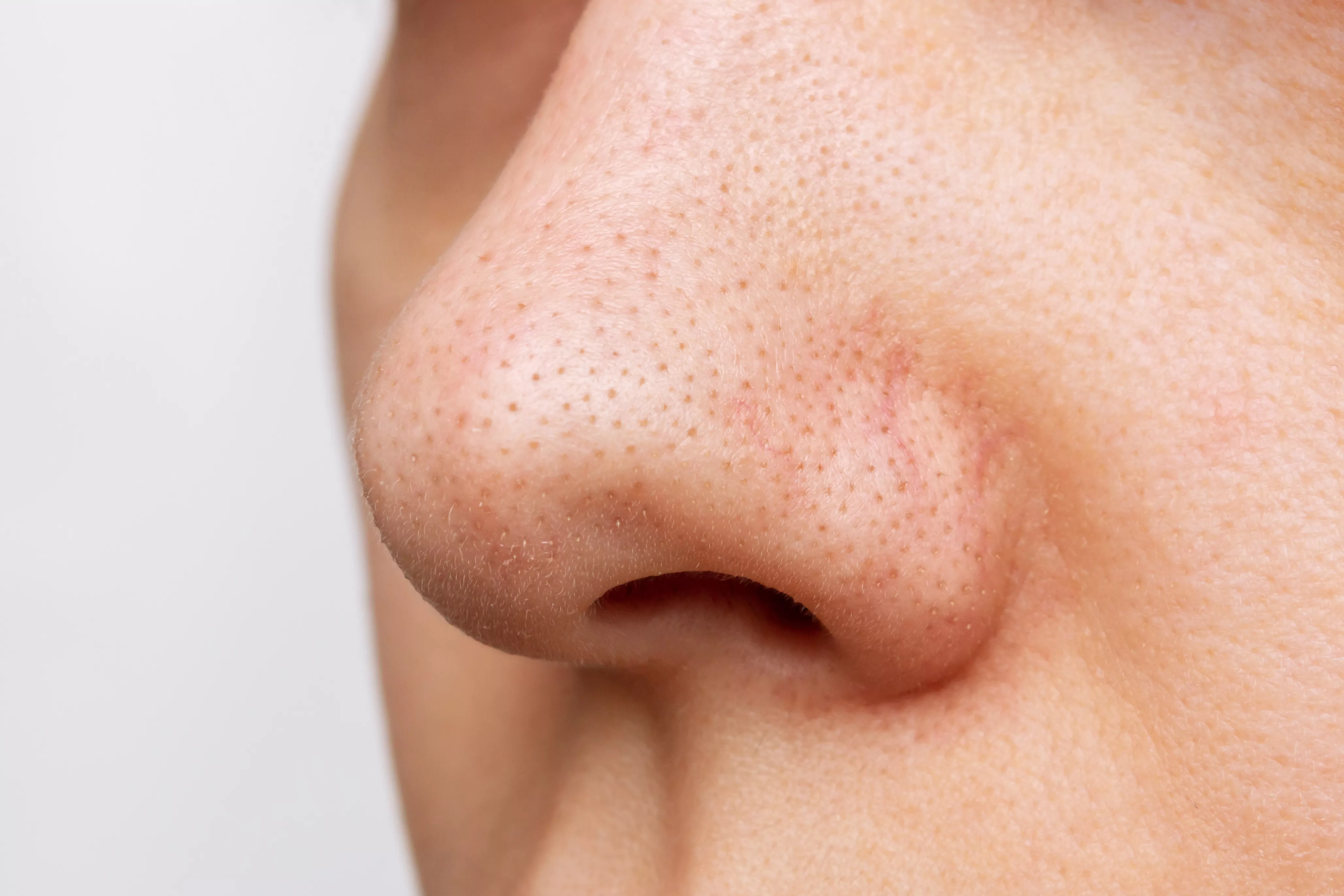 Verbonden opener affix Popping Blackheads on Your Nose Guide