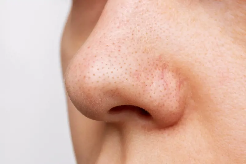 Popping Blackheads on Your Nose Guide