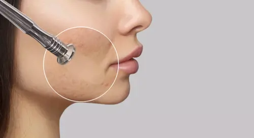 Microdermabrasion device in action